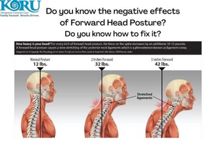 Can forward head posture be fixed