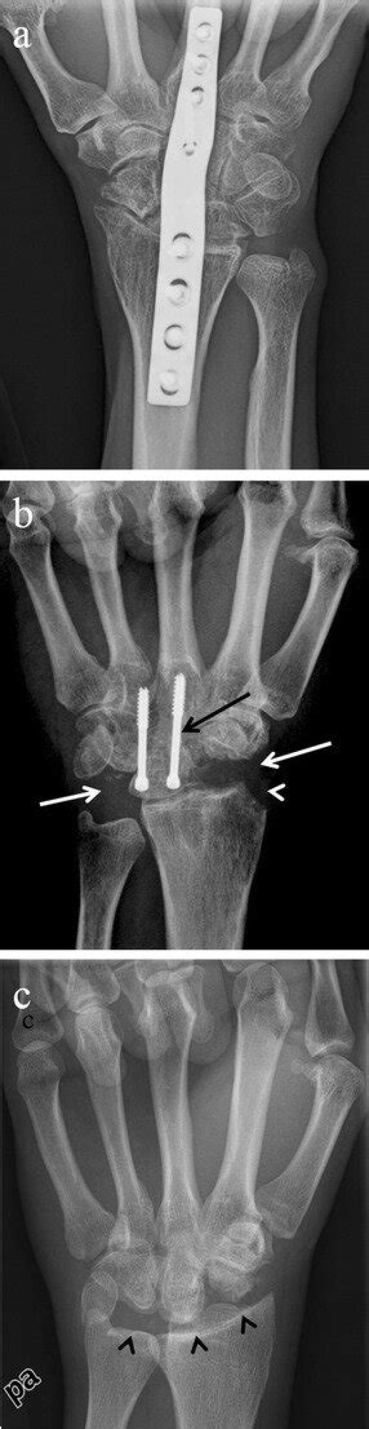 How do you treat a SLAC wrist