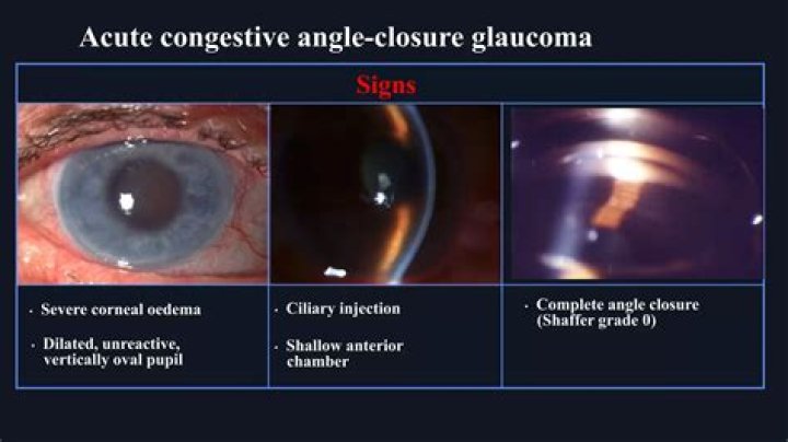 How do you treat an angle closure