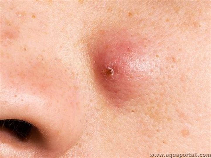 Pourquoi des kystes apparaissent