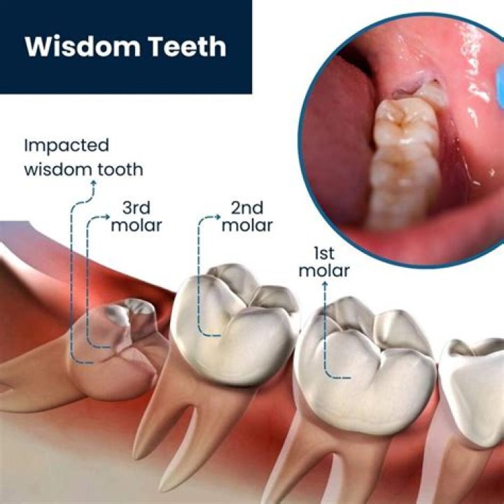 Should wisdom tooth be removed