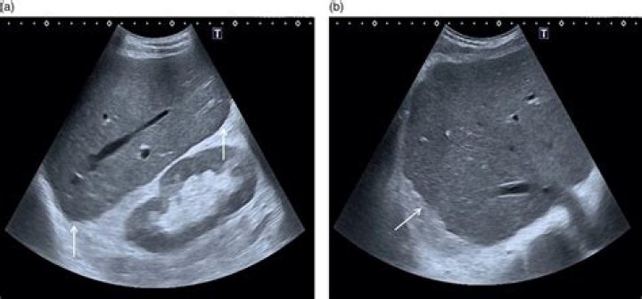What are nodules on the liver