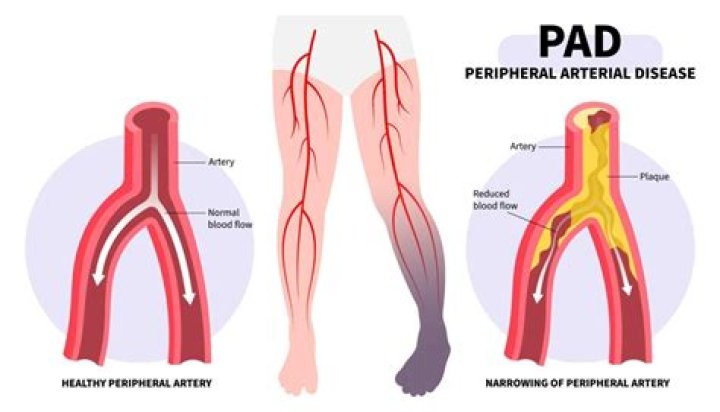 What are the disadvantages of angioplasty