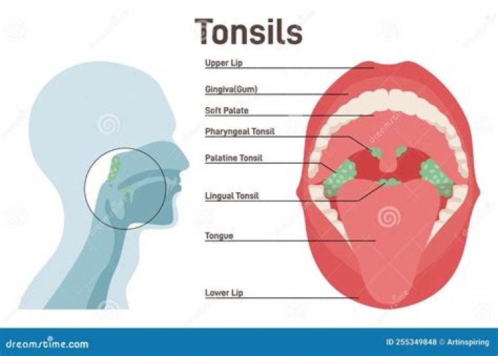 What are the types of tonsils