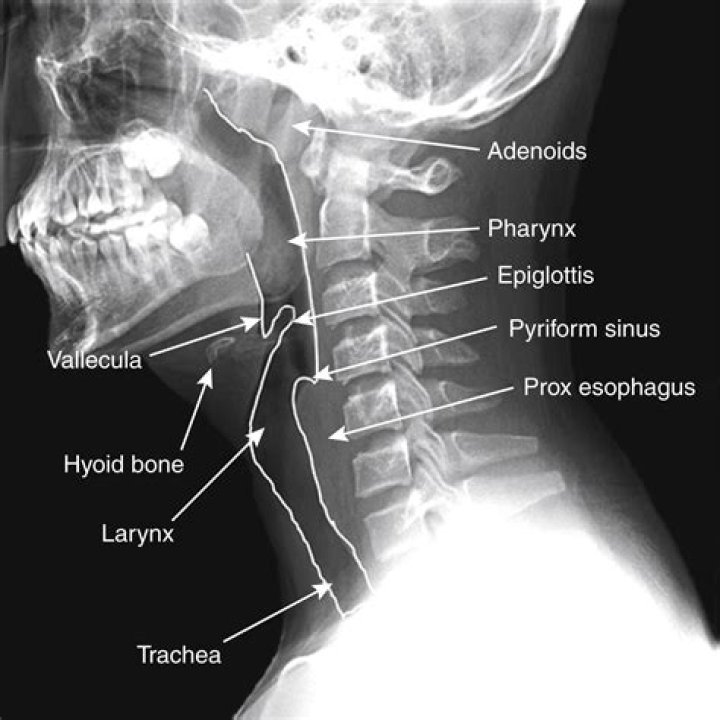 What can a neck X ray tell you