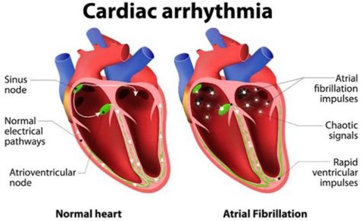 What causes atrial dysrhythmia