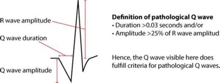 What does a large S wave indicate