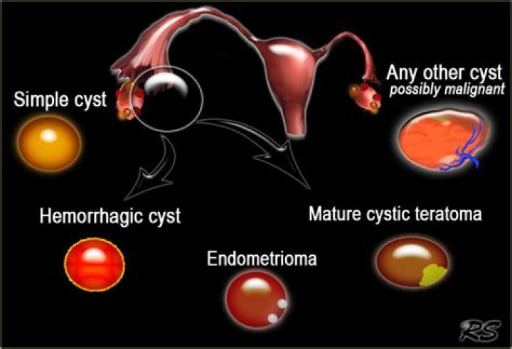 What is a simple ovarian cyst