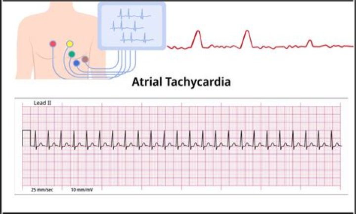 What is an atrial tachycardia