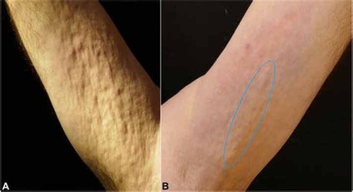 What is eosinophilic fasciitis