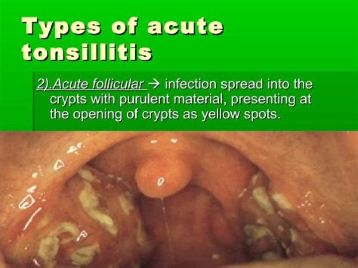 What is follicular tonsillitis