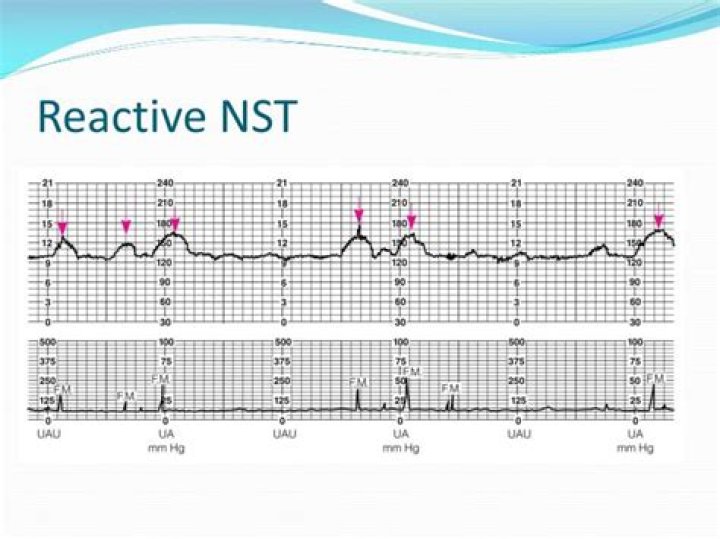 What makes a fetal strip reactive