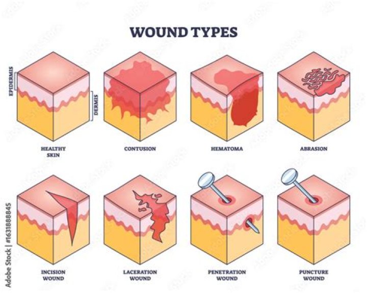 What type of wound is a skin tear