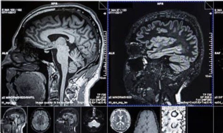 When is CT needed for head trauma