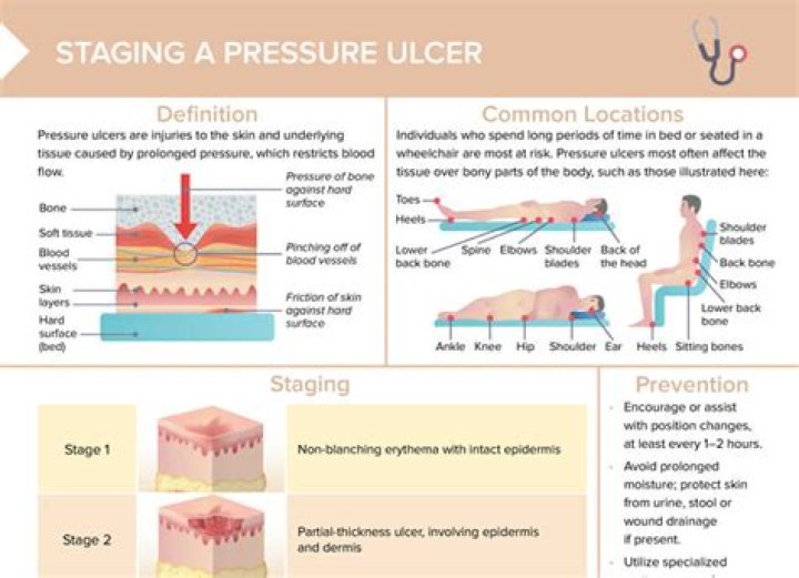 Where is a ischial pressure ulcer